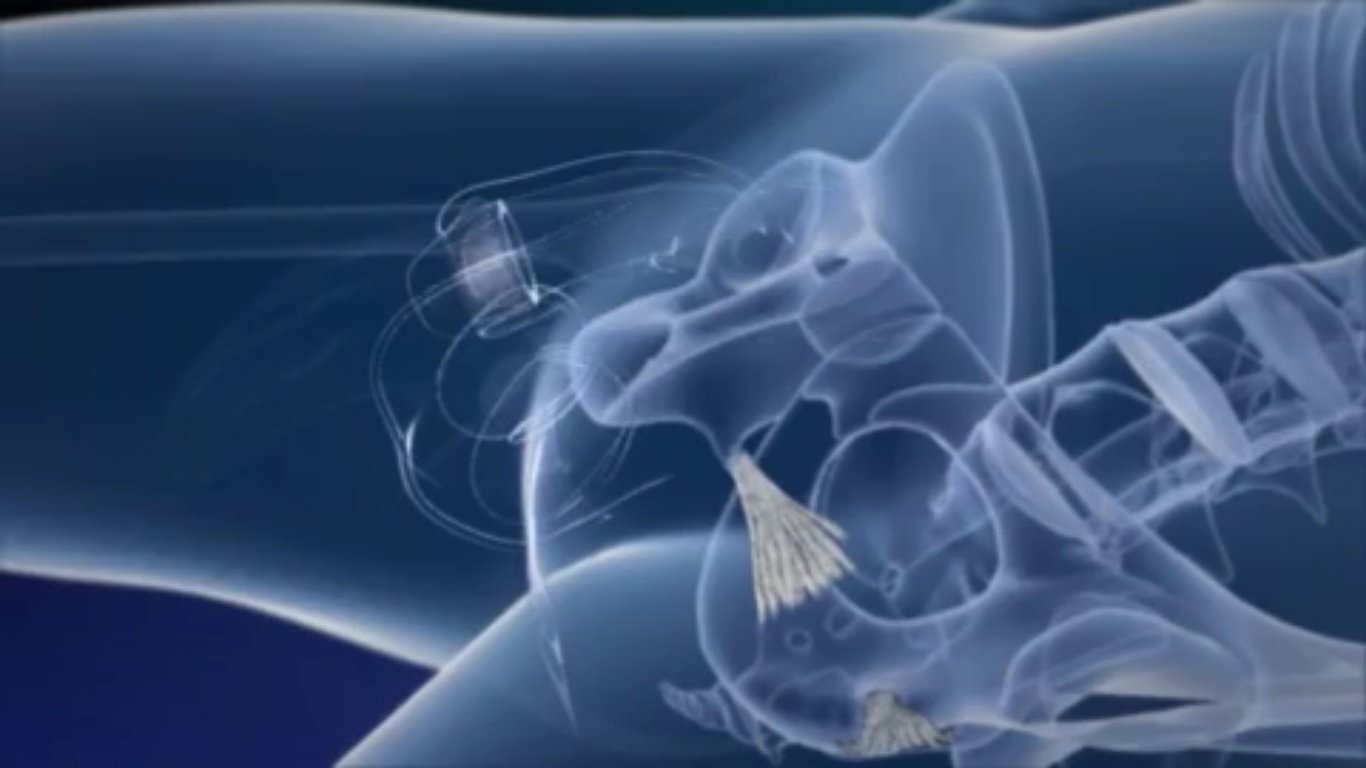 Vídeo mostra em detalhes o funcionamento da cirurgia de mudança de sexo Metrópoles