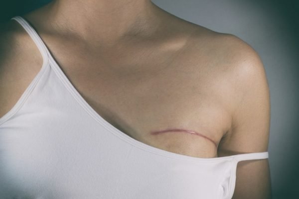 Câncer de mama cicatriz