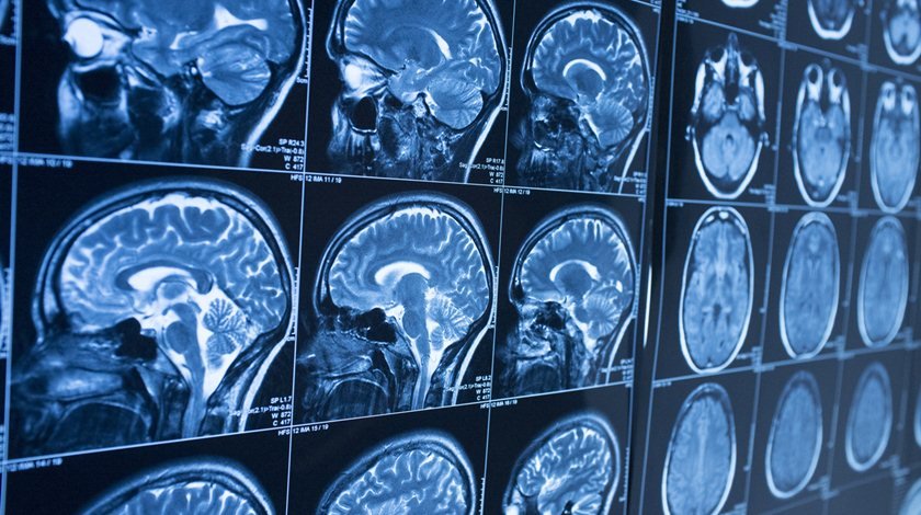 Head x-ray, brain in MRI