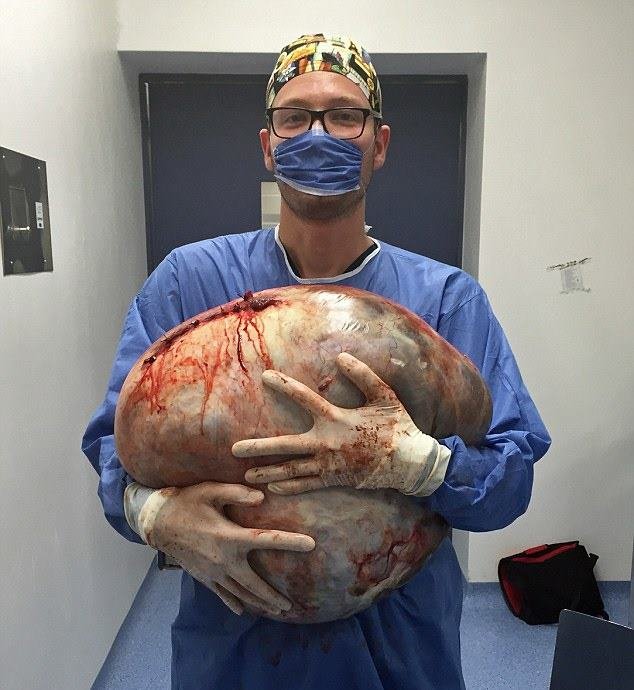 Médicos removem cisto de 32kg que crescia em ovário de jovem mexicana