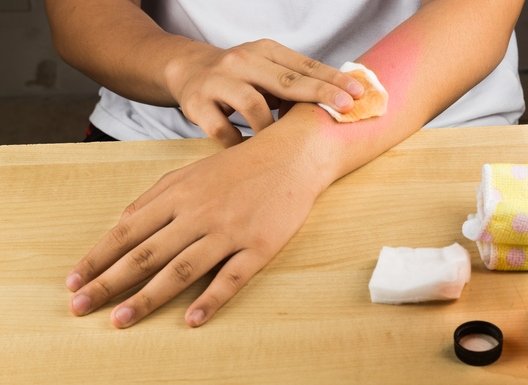 Apple cider vinegar natural remedy for itch, fungal, bruises, burns