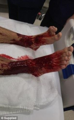 4303743A00000578-4767448-A_nurse_told_the_teenager_the_bites_might_have_been_from_sea_lic-a-18_1502101246323