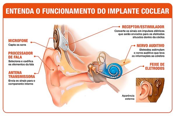 Imagem explica o implante coclear, tratamento para a surdez