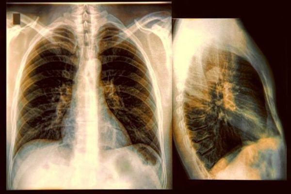 cancer de pulmão