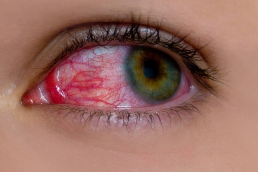 Olho vermelho, irritado, conjuntivite, olho rosa - Metrópoles