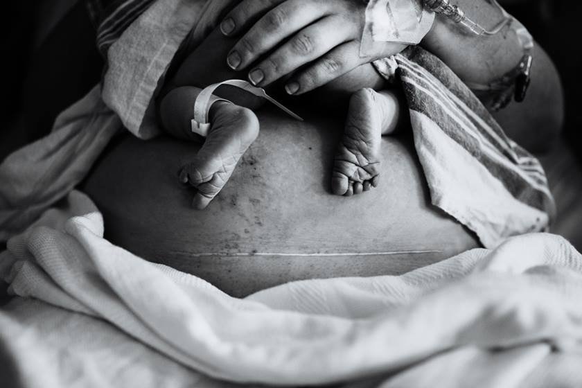 Imagem em preto e branco mostra barriga de mulher com a cicatriz da cesariana e os pés de um recém-nascido