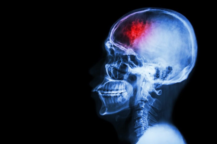 Imagem de raio x de uma cabeça, com mancha vermelha no cérebro - Metrópoles