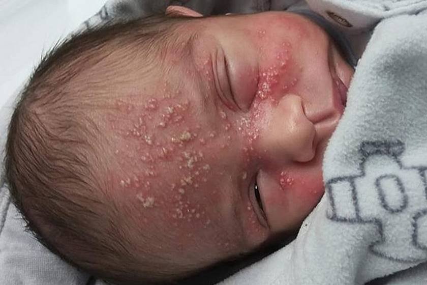 Herpes Em Bebes Pode Levar A Morte Saiba Como Prevenir