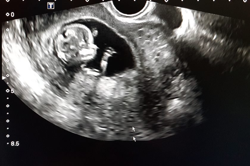 Photos of the child in the 12 week of pregnancy. Ultrasound procedure. Screening in the first trimester.