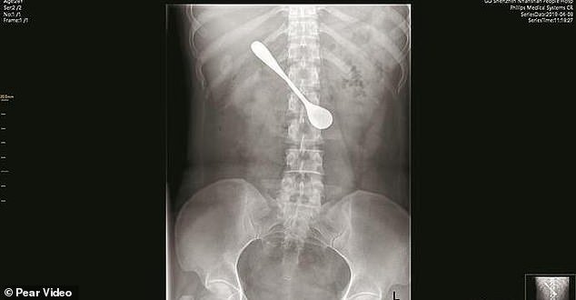 12335214-6927327-An_x_ray_image_shows_the_shadow_of_the_metal_spoon_in_the_female-a-14_1555410454480