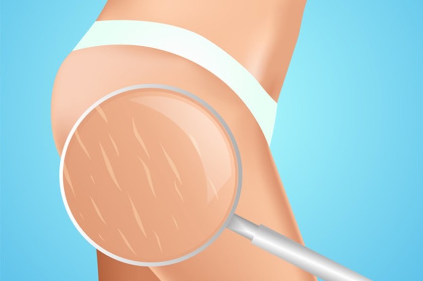 Xô, estrias! Confira dicas para evitar as tão temidas marcas na pele
