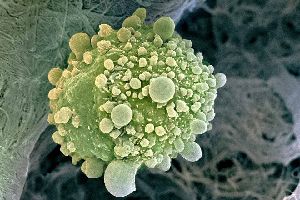 Células de câncer no pâncreas