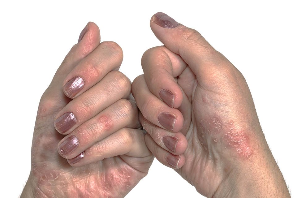 PSORIASE1