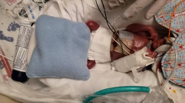 Bebe Nasce Com 300 Gramas E Surpreende Medicos Por Resistir Incrivel Bebe Nasce Com 300 Gramas E Surpreende Medicos Por Resistir Incrivel