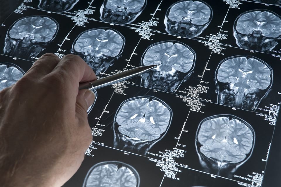 Imagem colorida mostra não apontando com caneta para exame de ressonância magnética de cérebro estado catatônico - Metrópoles
