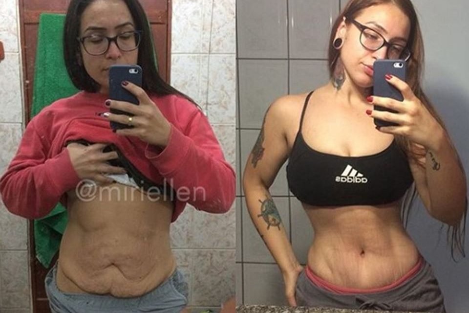 Cirurgia para retirada de pele da barriga