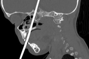 International Journal of Pediatric Otorhinolaryngology Case Reports
