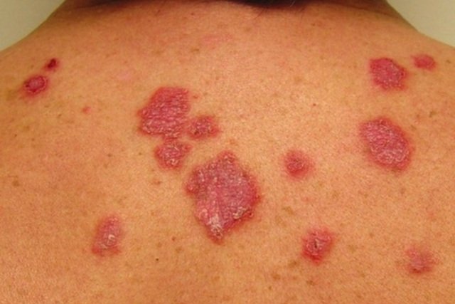 imagem de pessoa com pele coberta de lesões vermelhas na pele provocada pelo lúpus