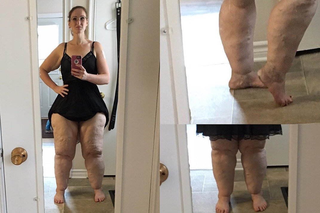 Mulher cria campanha para remover 20 litros de gordura das pernas