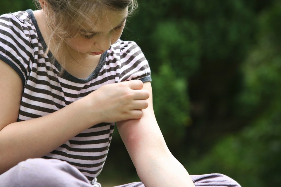 Cinco Dicas Para Cicatrizar Picadas De Mosquito Em Tempo Recorde Metr Poles