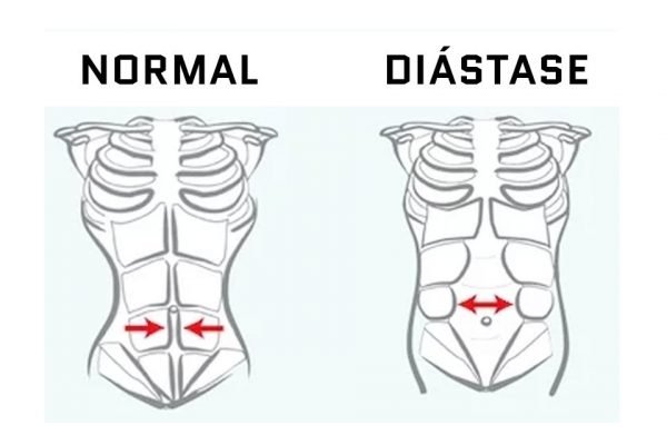 O que é diástase abdominal e o que pode ser feito para corrigir