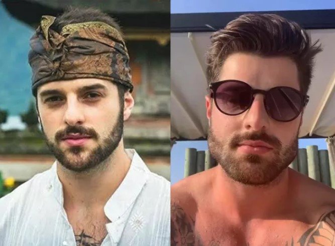 Veja o antes e depois de famosos que fizeram harmonização facial