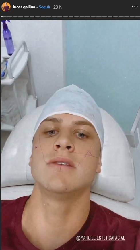 Lucas Gallina preenchimento labial