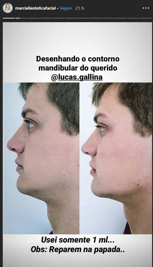 Lucas Gallina preenchimento labial