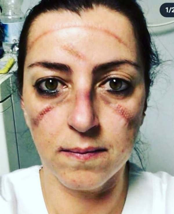 Rosto de mulher com marcas de óculos de proteção e de máscaras