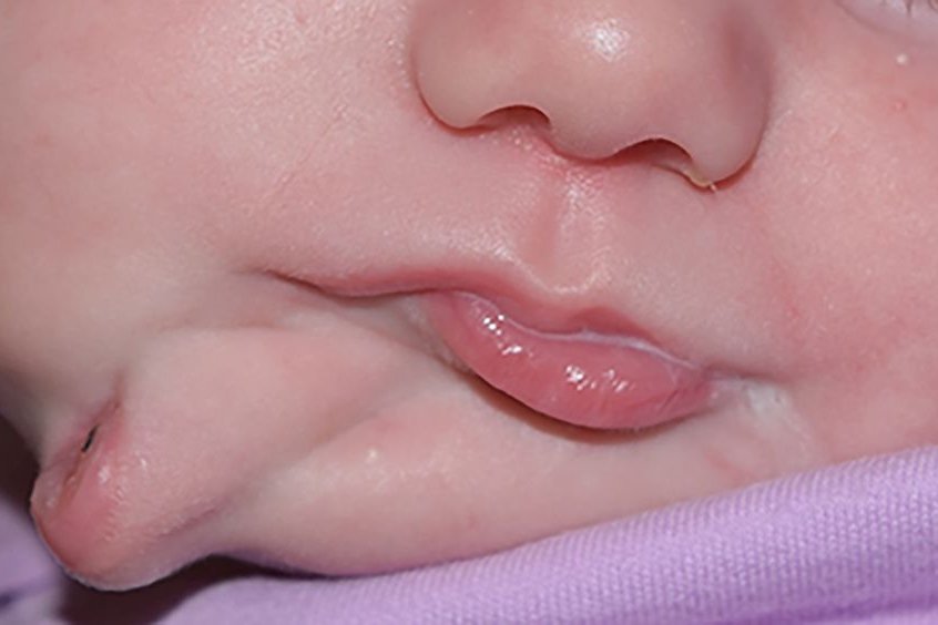 Bebê-com-má-formação-facial