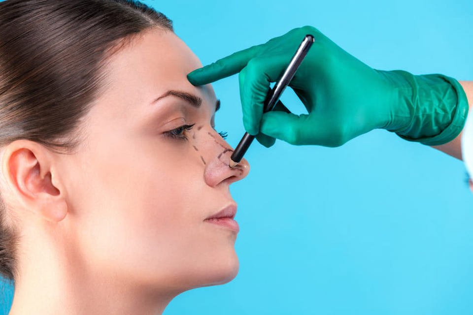 rinoplastia