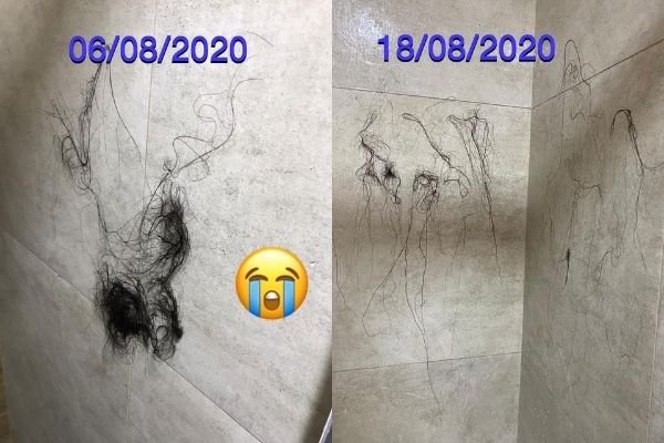 perda de cabelo covid-19