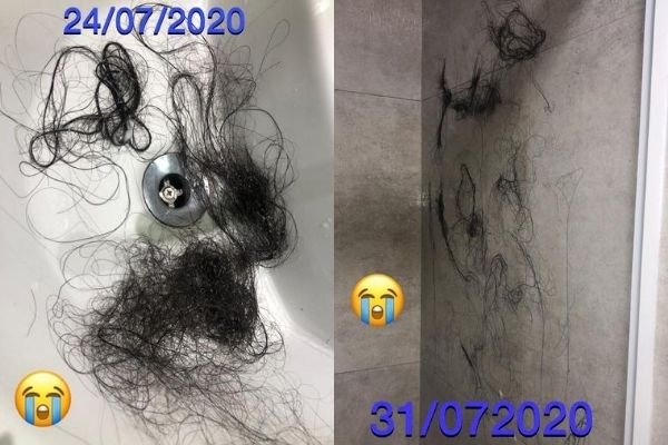 perda de cabelo covid-19