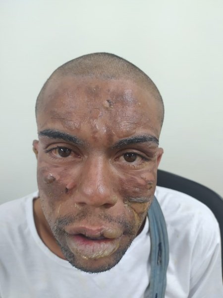 homem queimado
