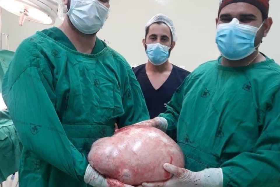 Tumor de 20kg é retirado do ovário de uma paciente no Acre