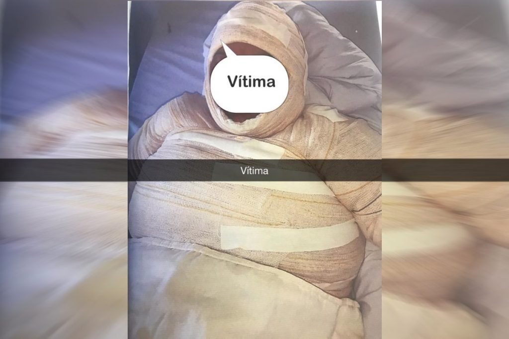 mulher queimada