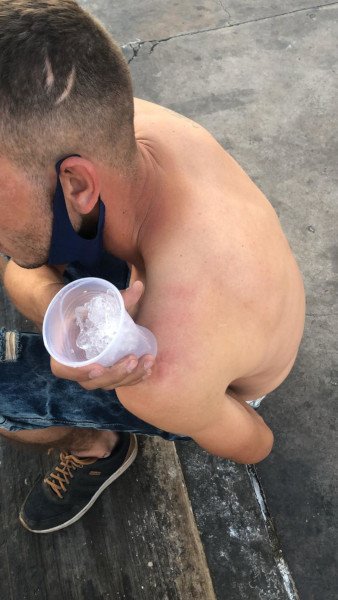 Ambulante mostra machucados