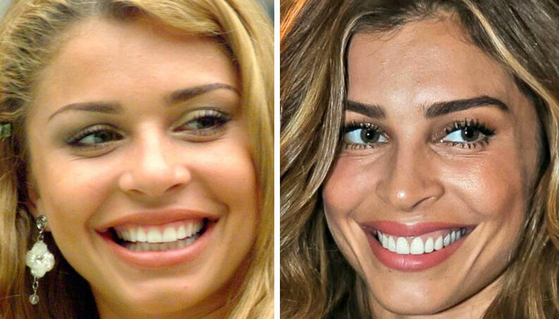 Lentes de contato dental antes e depois
