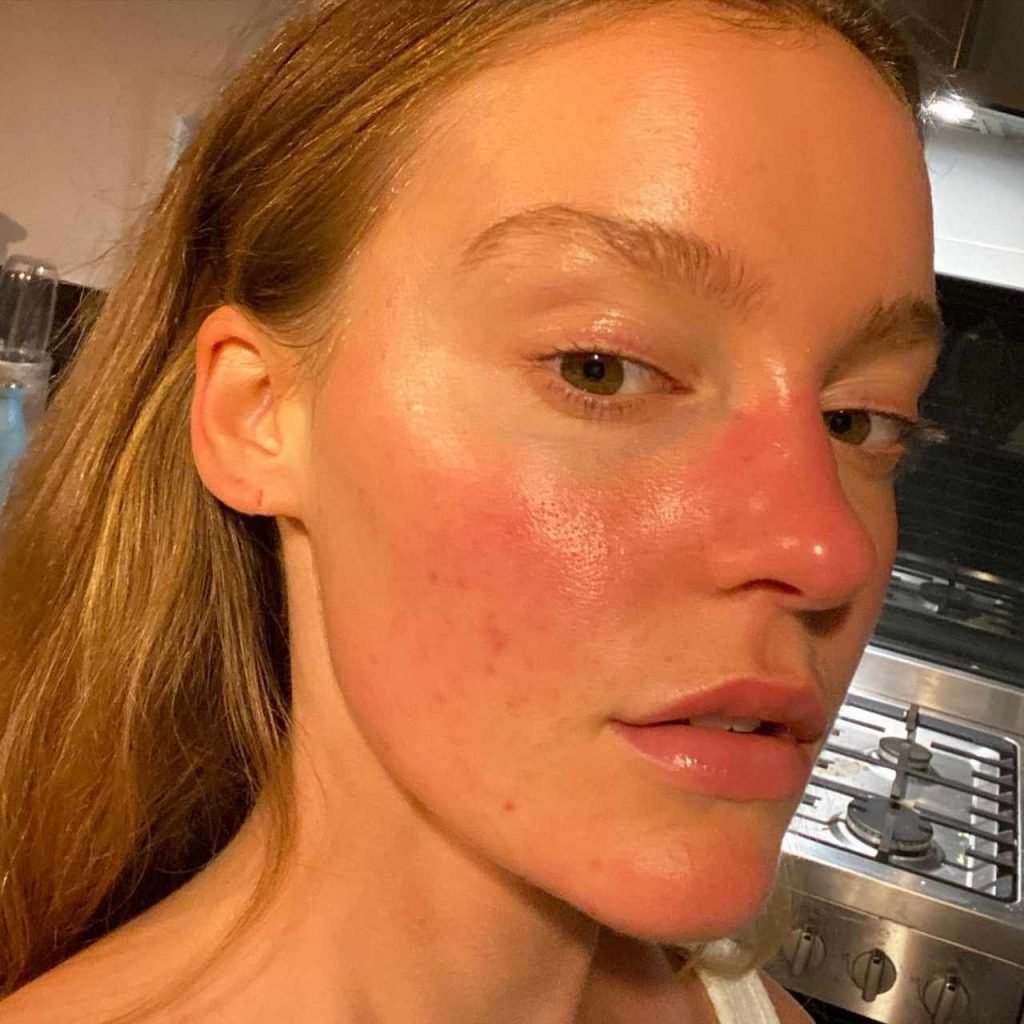 modelo com acne