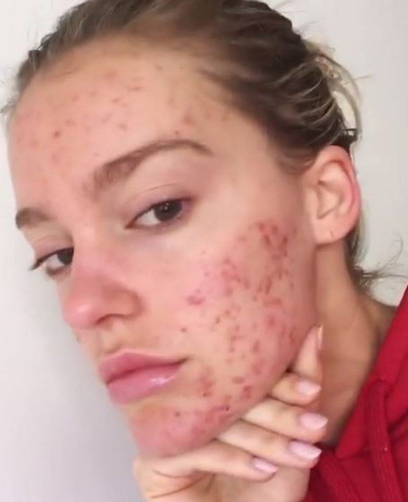 modelo com acne