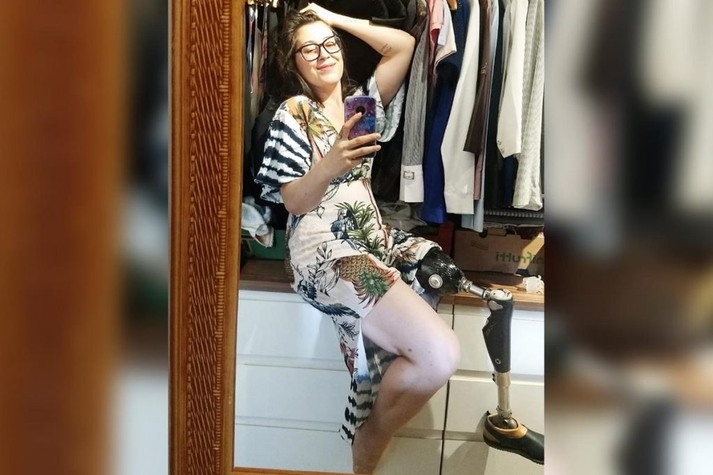 A jornalista Elizângela Toniolo, que perdeu uma perna por causa de um tumor