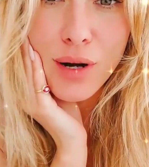 Lívia Andrade Rosácea