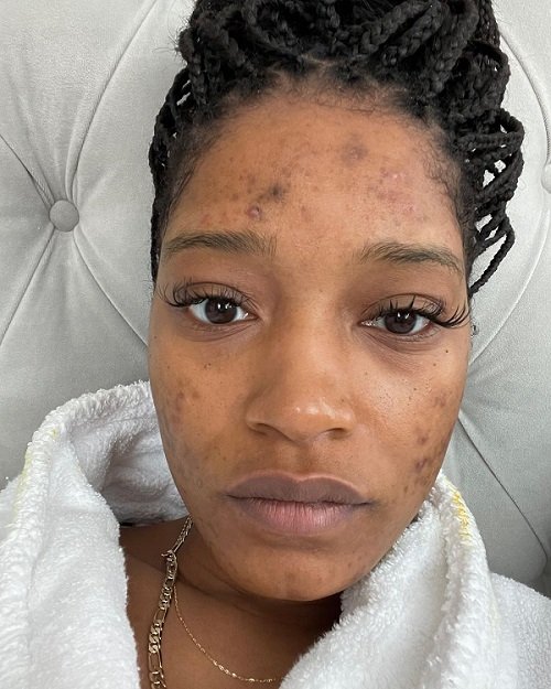 mulher com acnes no rosto