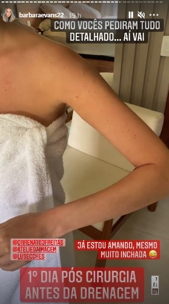 Barbara Evans faz lipoaspiração no braço