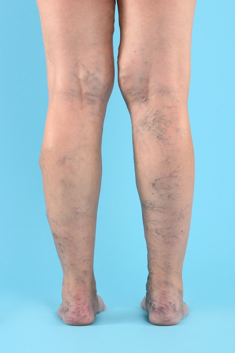 Varizes - pernas