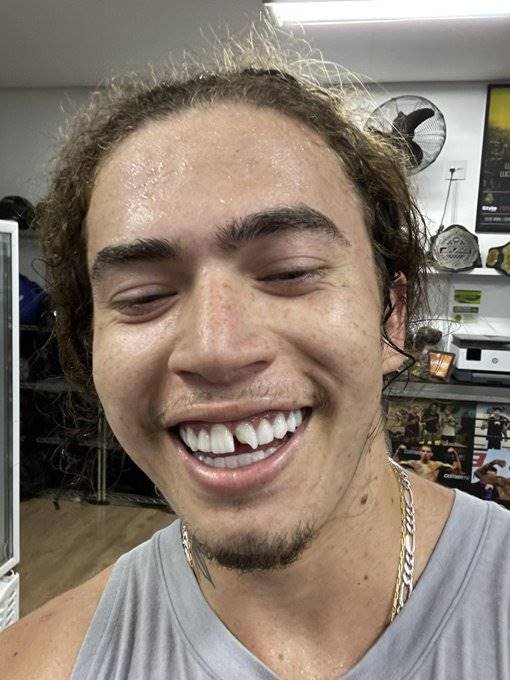 Whindersson Nunes sem dente