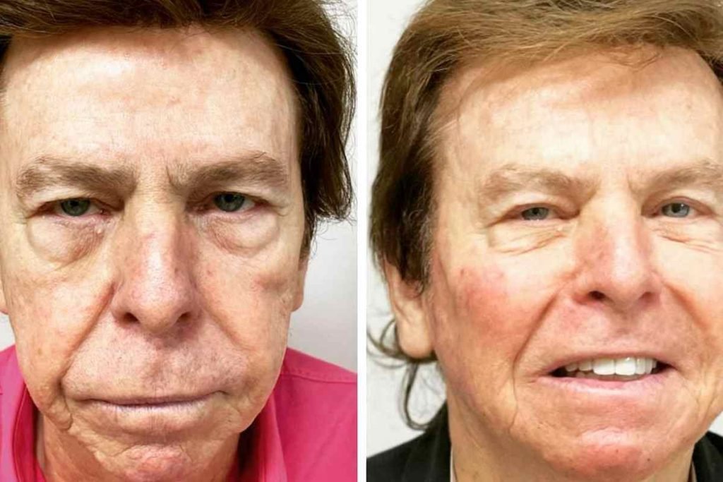 Nelson Rubens fala sobre harmonização facial e rebate: “Não tenho 83 anos” Nelson Rubens
