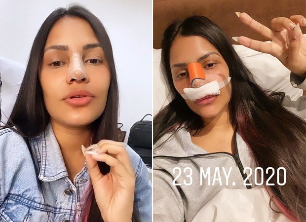 Rinoplastia: veja o antes e depois de ex-BBBs que já fizeram a cirurgia