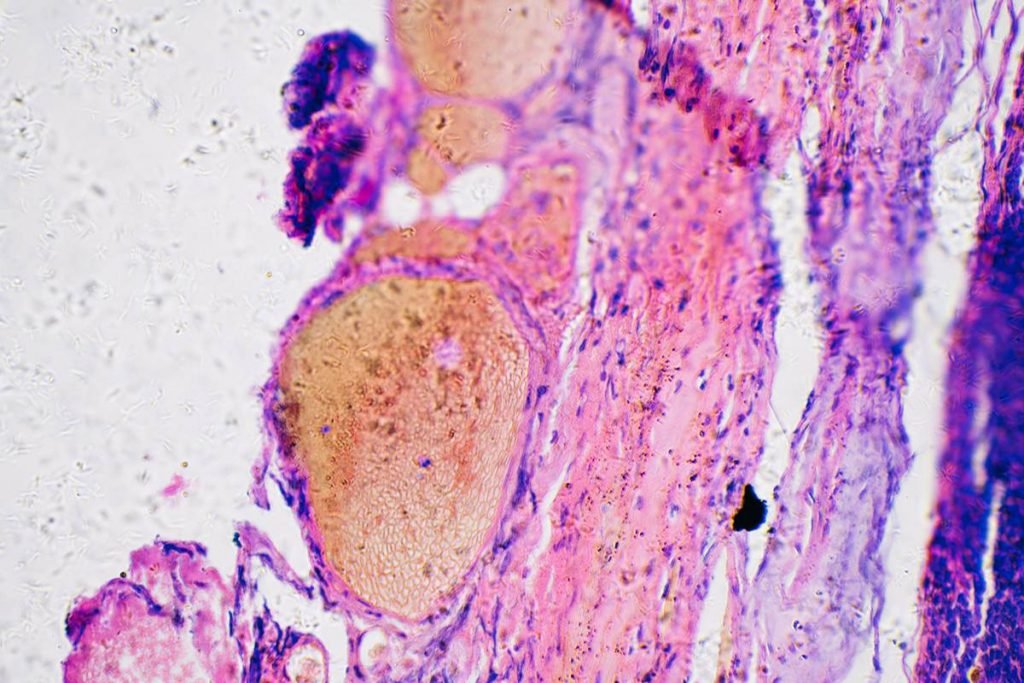 Melanoma cancer no microscopio