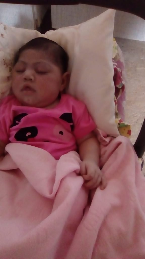 Bebê com microcefalia